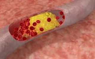 Норма холестерина в крови у мужчин – таблица, что делать при повышении или понижении холестерина