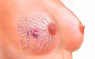 Причины, виды, классификация и способы лечения опухоли в груди