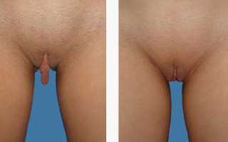 Операция по коррекции половых губ. Подготовка к ней и послеоперационный период
