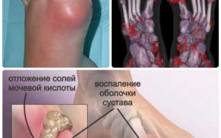 Подагра на ногах: тенденции в диагностике и лечении патологии