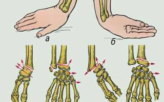 Артроз большого пальца руки: лечение медикаментами и физиотерапия