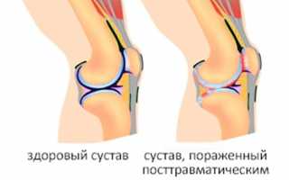 Как лечить инфекционный артрит коленного сустава: признаки болезни, схемы лечения