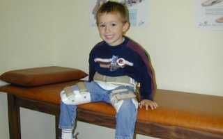 Болезнь Пертеса: причины возникновения у детей, симптоматика, лечение