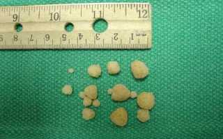 Виды, распространенные симптомы и виды лечения камней в мочевом пузыре