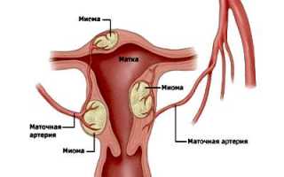 Причины, симптомы и лечение центрипетального роста миомы матки