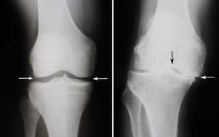 ДОА — деформирующий остеоартроз коленного сустава