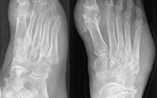 Артроз большого пальца ноги: этиология, клиническая симптоматика, тактика лечения