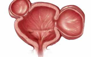 Виды, причины и лечение кисты уретры у женщин