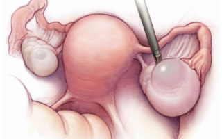 Операция по удалению кисты яичников, возможные осложнения и последствия