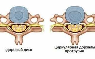 Что такое циркулярная протрузия диска: виды и стадии болезни, схемы лечения