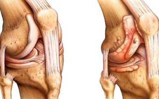 Чем отличается артрит от артроза коленного сустава: анализ признаков болезней