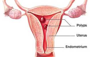 Что такое аденоматозный полип эндометрия и пути его лечения. Причины и симптомы патологии