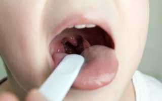 Тонзиллит хронический у детей: когда миндалины сильно увеличены