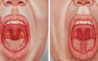 Миндалины в горле: как возникает воспаление