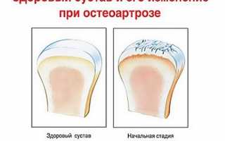 Остеоартроз коленного сустава первой степени: лечение, причины, симптомы недуга