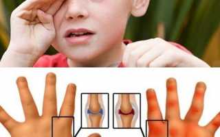Ювенильный ревматоидный артрит у детей: лечение, причины, симптомы болезни