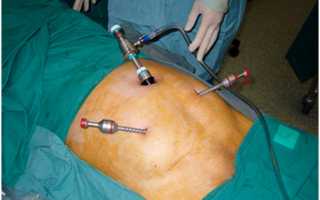 Этапы операции лапароскопии варицколе. Ее преимущества и недостатки