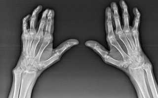 Артроз кисти рук и его лечение, причины и симптомы заболевания