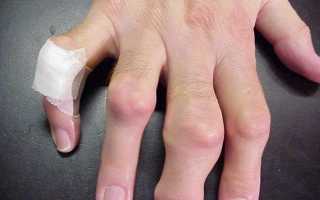 Как лечить артрит на пальцах рук, зависит от его классификации