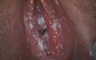 Основные причины и лечение белого налета на половых губах