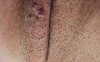 Причины, лечение и профилактика черных точек на половых губах
