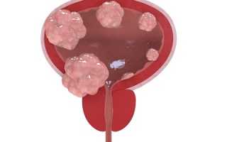 Возможные причины, распространенные симптомы и пути лечения папилломы мочевого пузыря