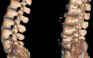 Остеохондроз спины: как лечить, симптомы, полное описание заболевания