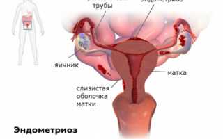 Характерные причины, пути лечения и профилактика эндометриоза яичников