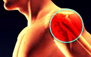Лечение хондроза плечевого сустава медикаментами, массажем, народными средствами