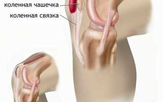 Бурсит коленного сустава — полное описание заболевания, симптомы и лечение