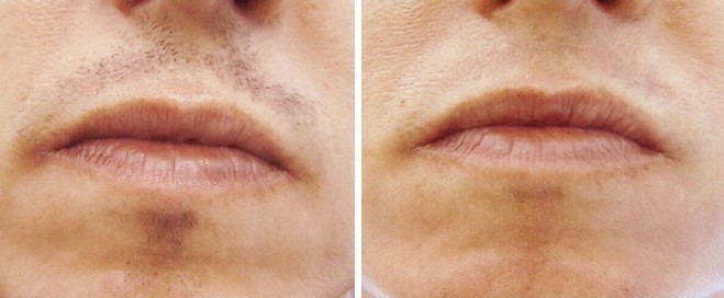 laser-hair-removal-upper-lip-before-after